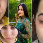 3777610056 urfi javed face fans surgery filmibeat