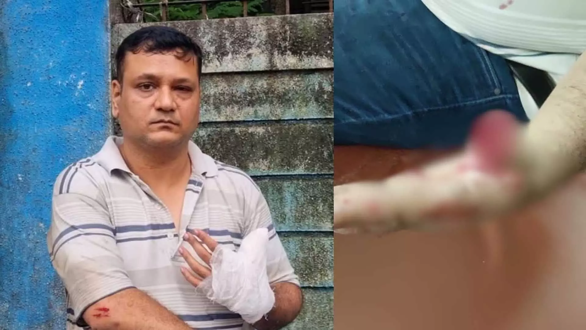 Society Ka Jhagda – Housing Society Chairman Ne Allegedly Society Member Ka Anghuta (Thumb) Chaba Liya At Dahisar