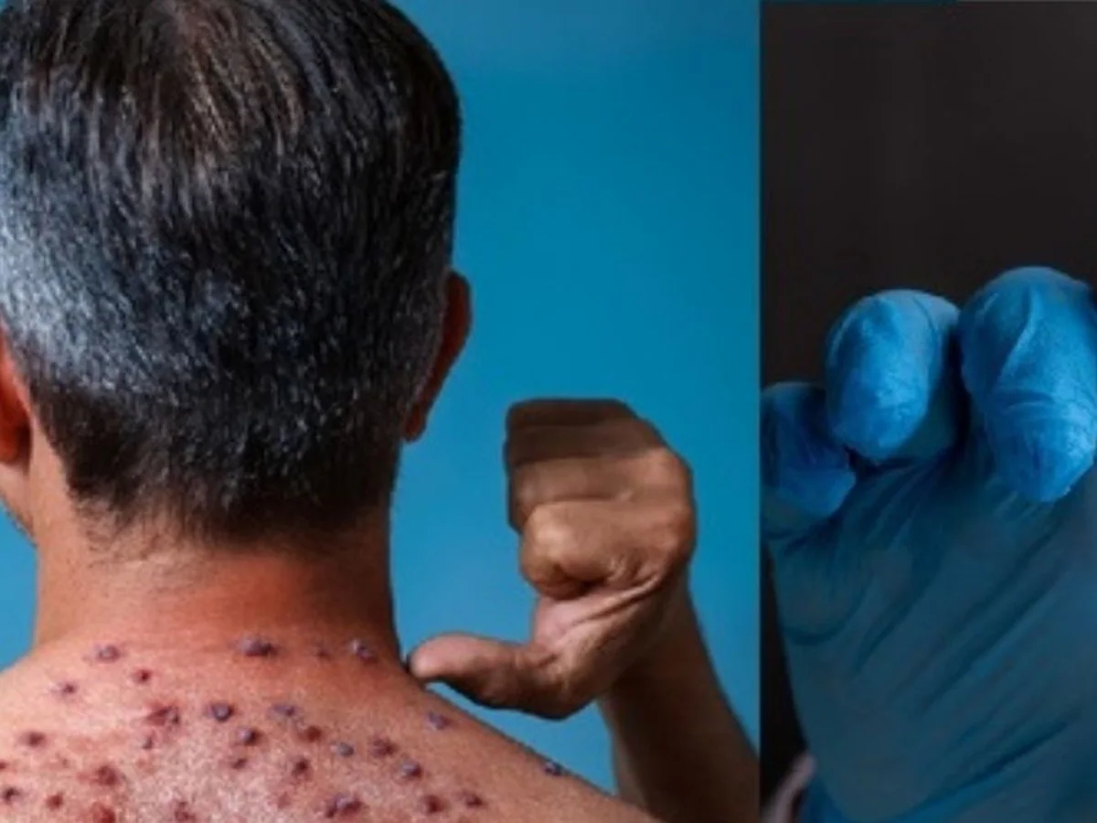 Monkeypox ka case Chennai me mila, sabhi states ko Guidlines issue kiya gaya