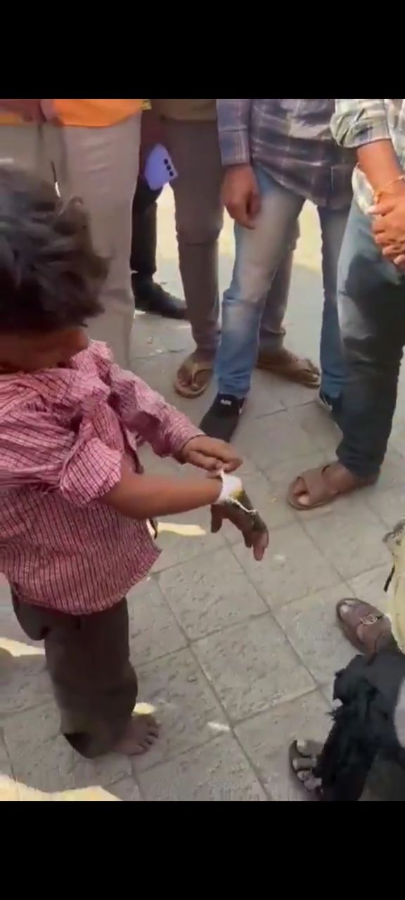 Bheek Mangte Bachche, Fake Burns Injury, Pardafash Kiya Alert Local Ne At Pune