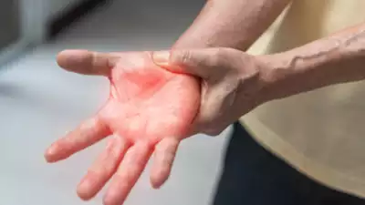 Beemari Guillain Barre Syndrome Ke Casses 100 Se Zyada Hue Pune Me, 1 Ki Death Hogayi, Sarkar Alert Mode Par